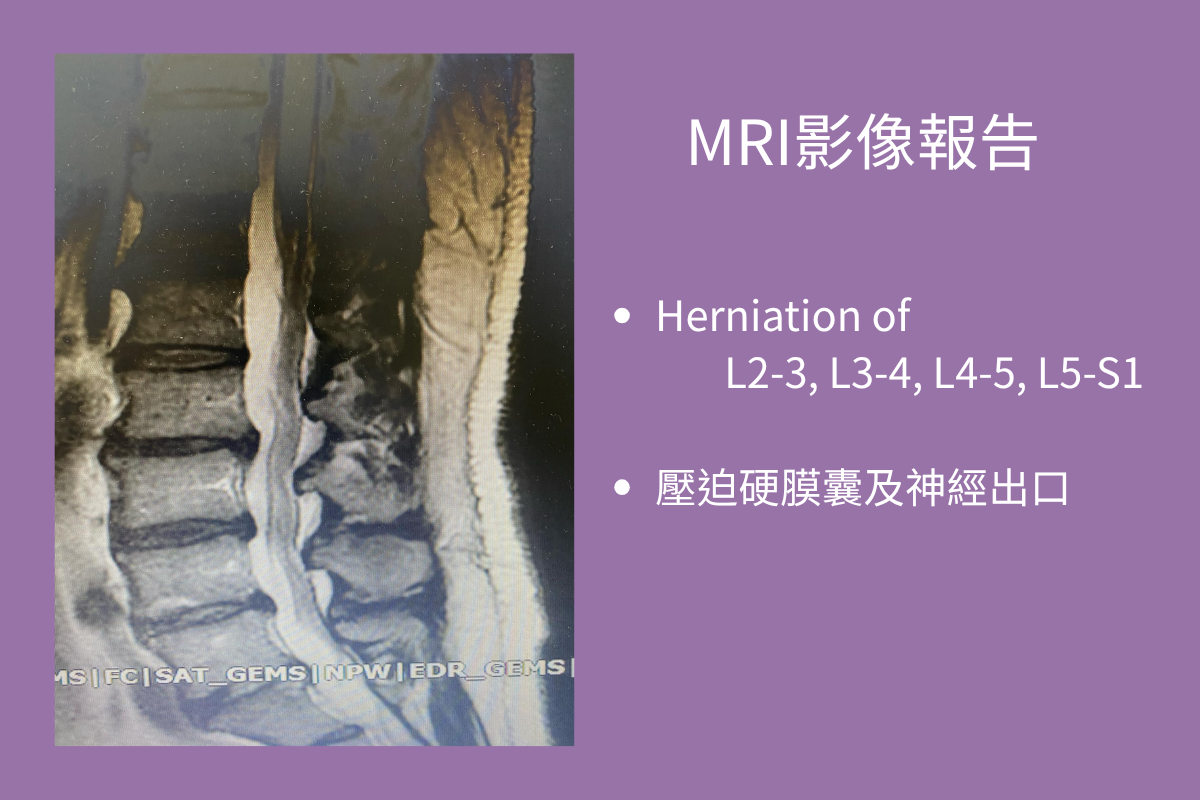 【雲玖醫案-針刀-職業司機的腰椎危機02-高雄】